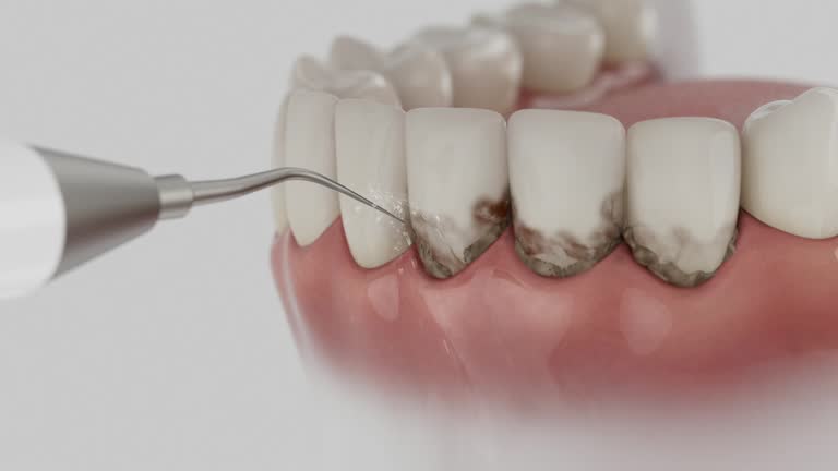 Trusted Dental Crowns And Bridges service in Fridley, MN - Dentist Open Now